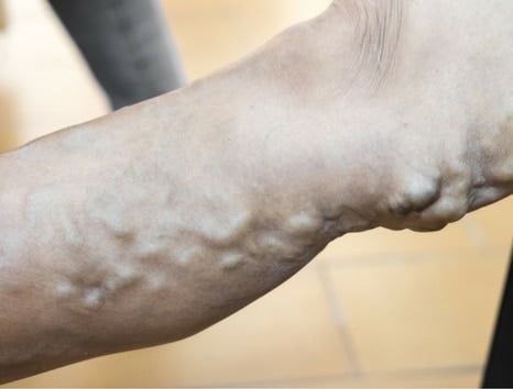 what causes varicose veins in legs - Vein Clinic Perth