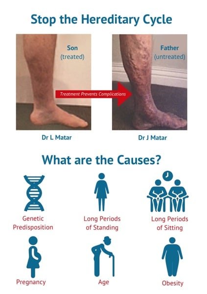 what are the causes of varicose veins in legs
