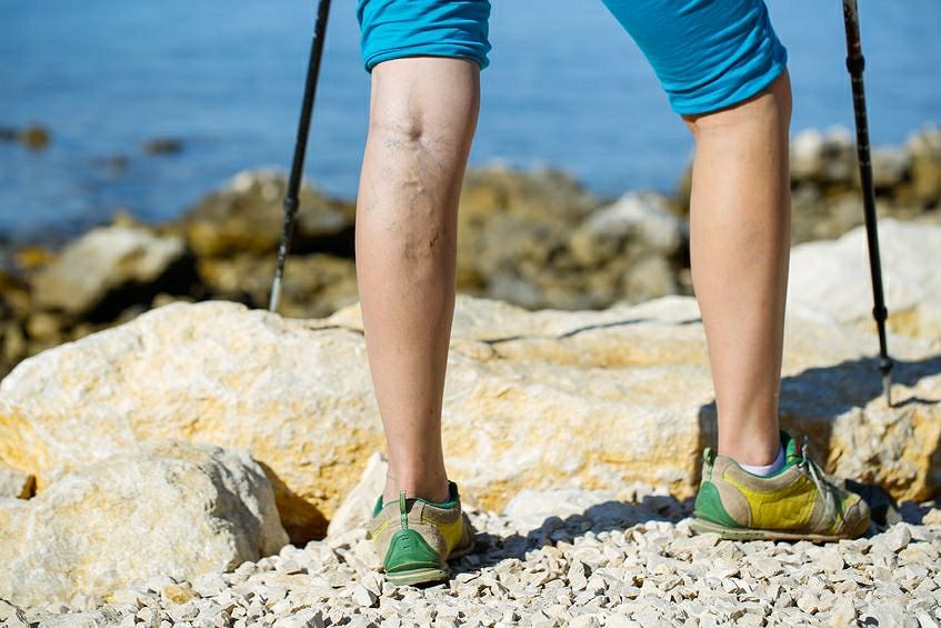 how to get rid of varicose veins perth