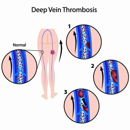 Deep Vein Thrombosis Treatment Perth