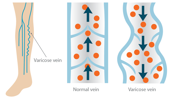 Varicose veins legs perth