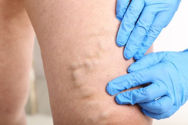 What are the health risks of varicose veins?