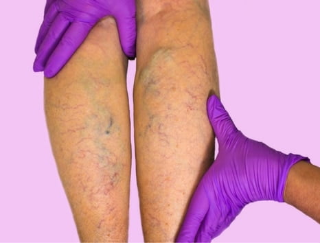 What are the different types of vein treatment?