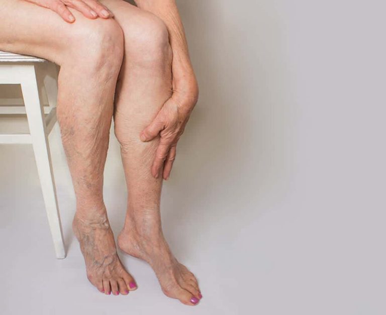 What is Sclerotherapy and How Does it Work?