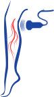 Ultrasound Guided Foam Sclerotherapy