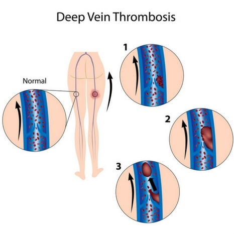 Deep Vein Thrombosis causes treatment Perth
