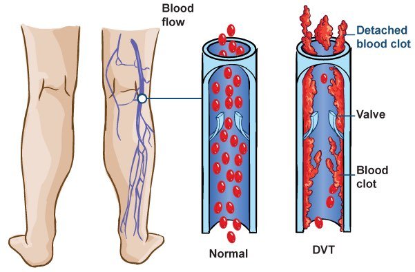 Deep Vein Thrombosis DVT Symptoms Clot - Vein Clinic Perth